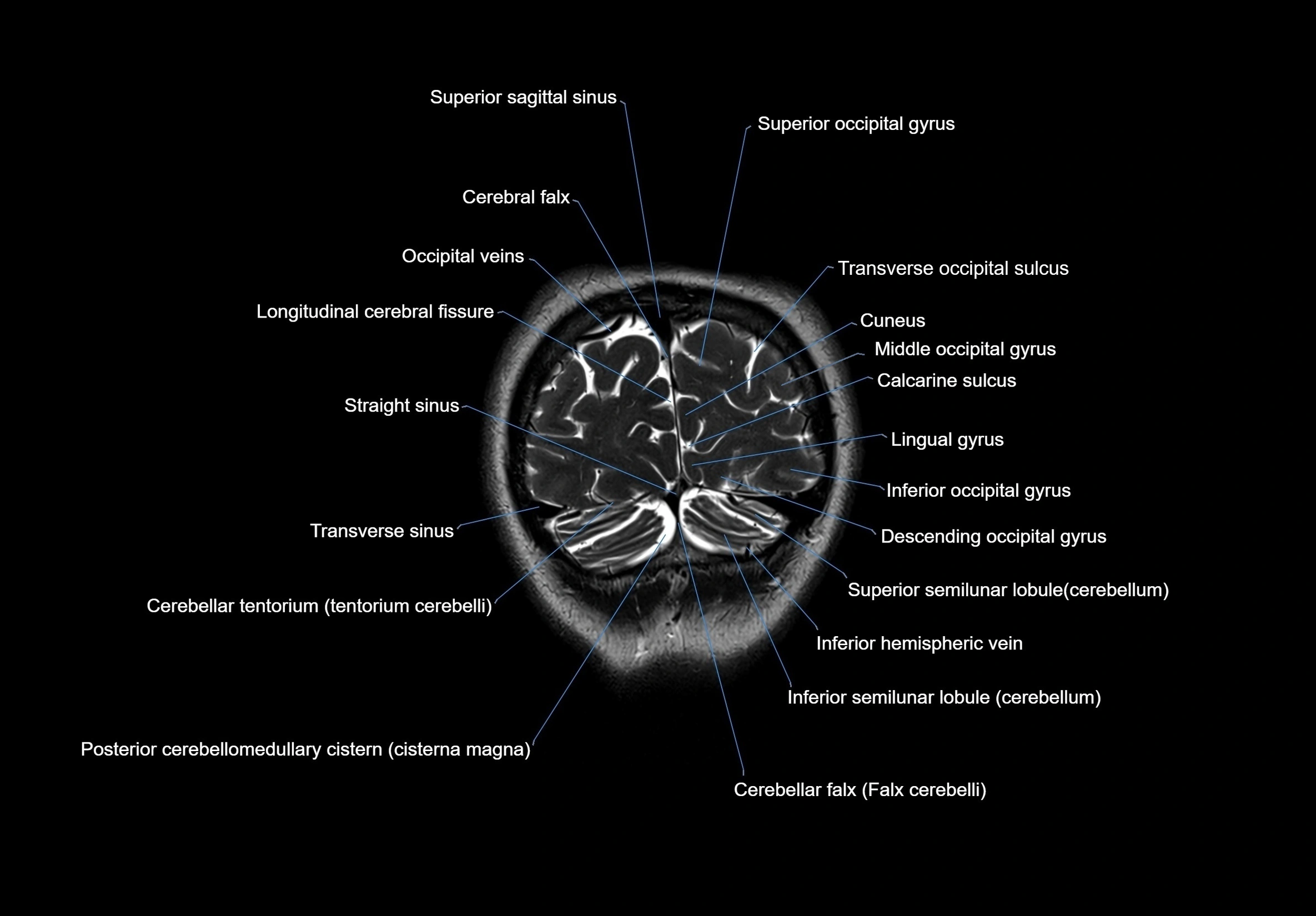 MRI Brain coronal cross sectional labelled anatomy 3T image  -img-00001-00067.webp